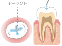 シーラント