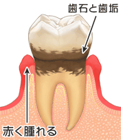 虫歯のイラスト